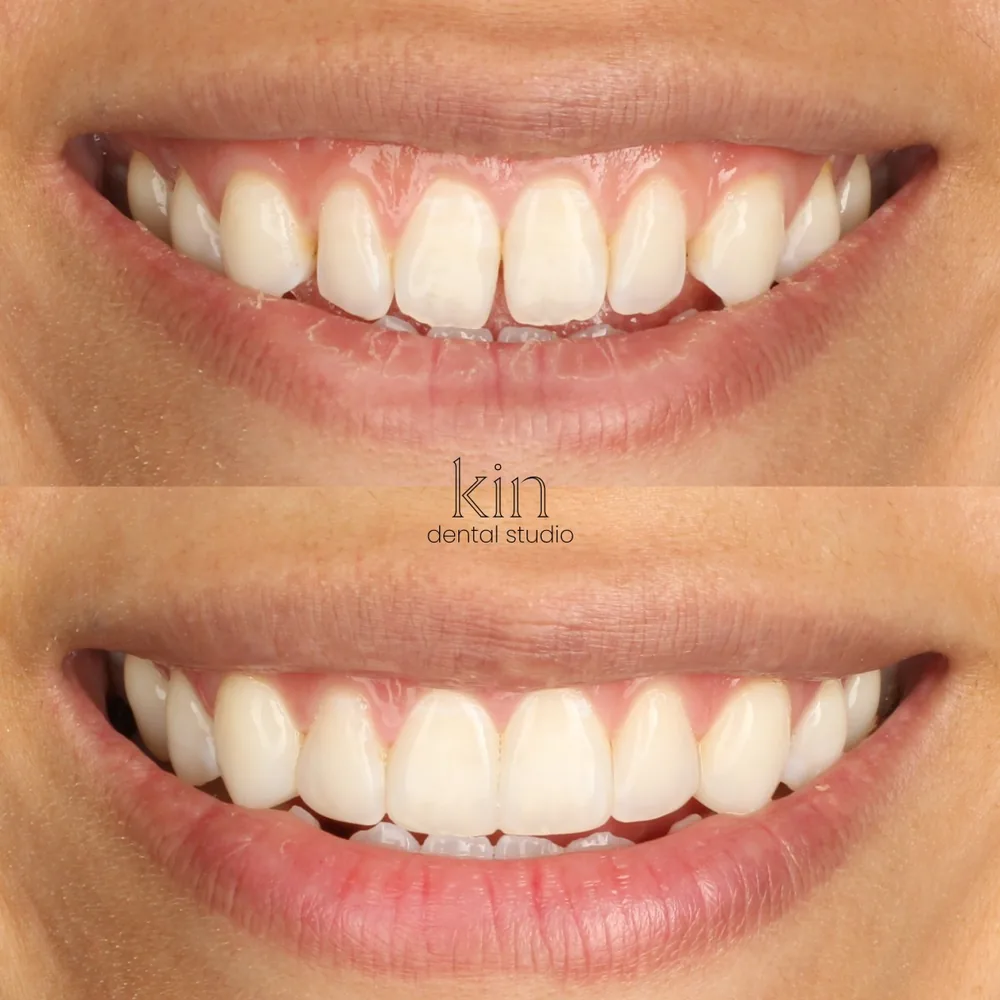Before and after of the patient’s smile from the front: gaps and shorter, discoloured teeth above, fuller and evenly shaped teeth below.