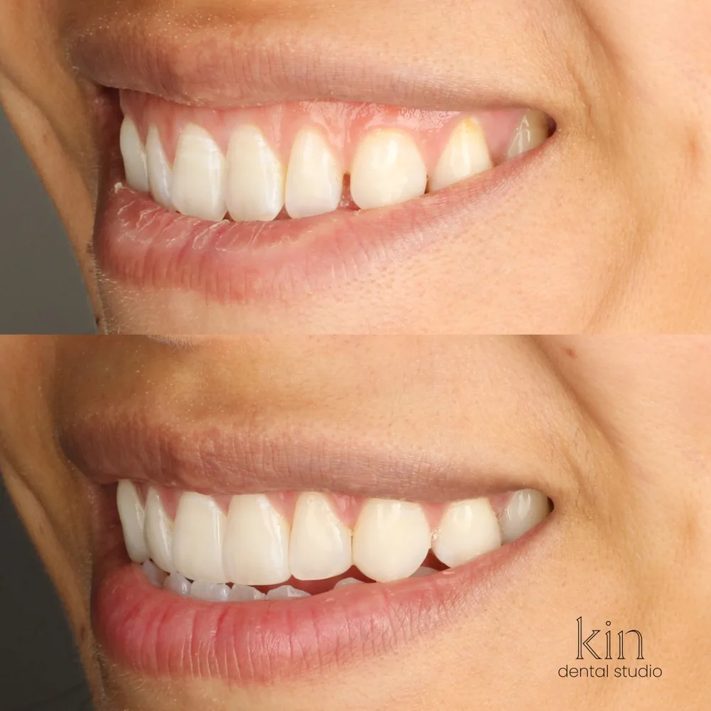 Before and after of the same smile from a three-quarter angle, showing the corrected tooth length along the smile line.