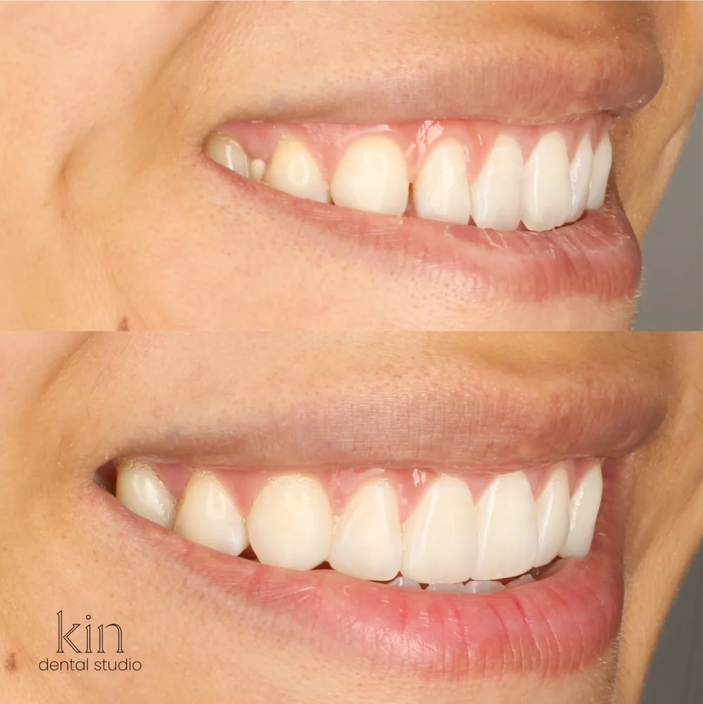 Before and after of the same smile from the opposite three-quarter angle, showing the improved shape and colour.