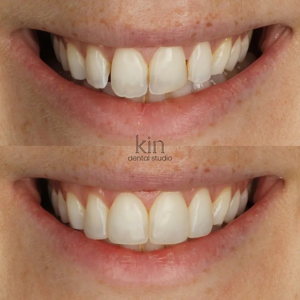 Before and after of the patient’s full smile, with the gap between the front teeth closed.
