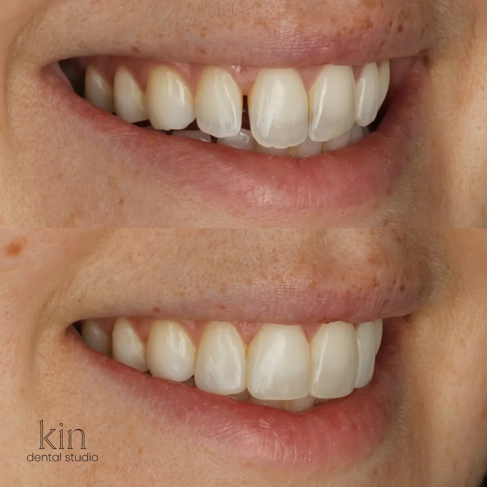 Before and after of the same smile from a three-quarter angle, showing improved balance along the smile line.