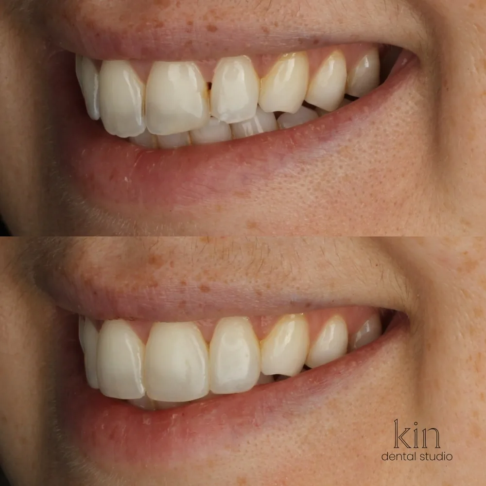 Before and after of the same smile from the opposite angle, showing the evened tooth edges.