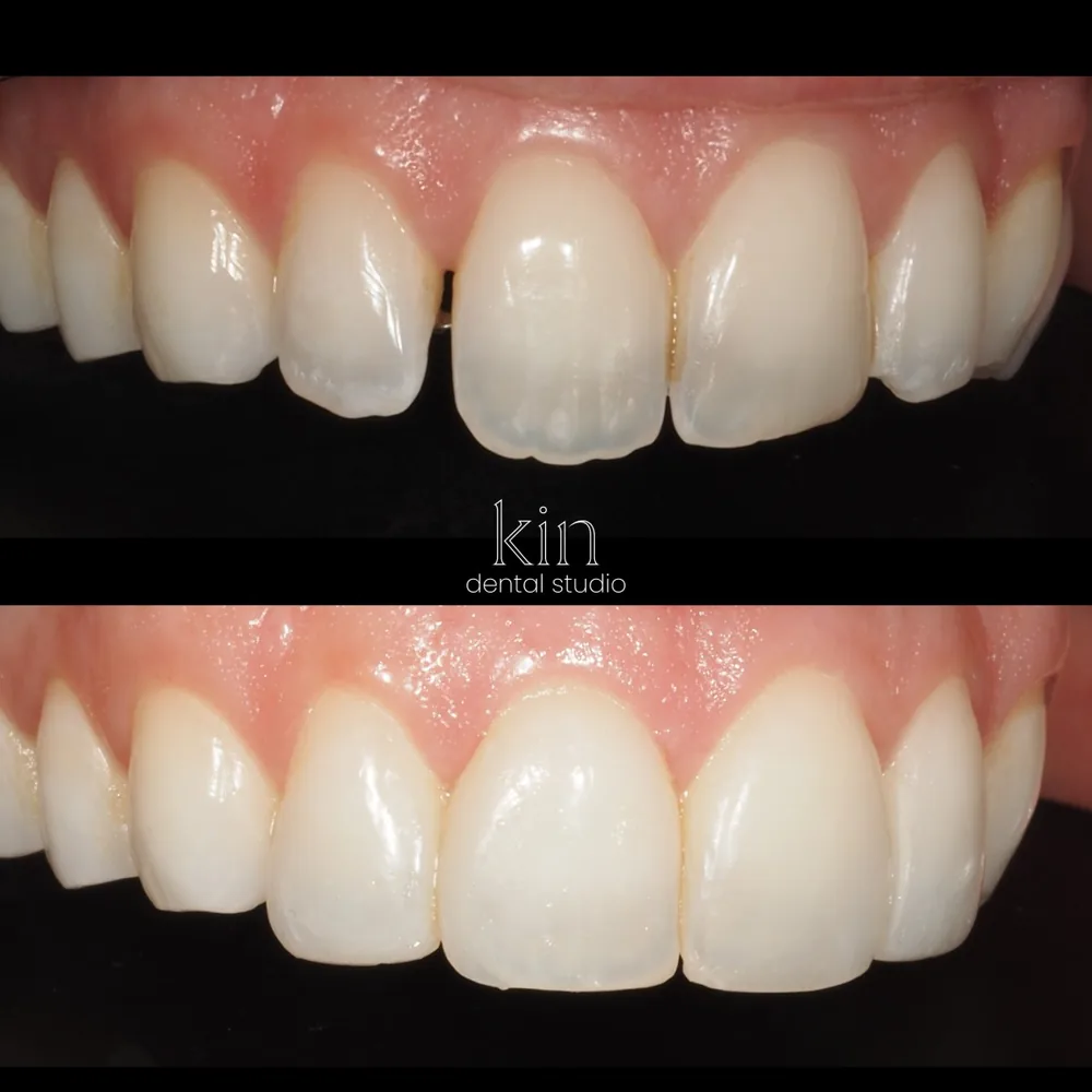 Before and after close-up from a second angle, showing the restored symmetry across the front teeth.
