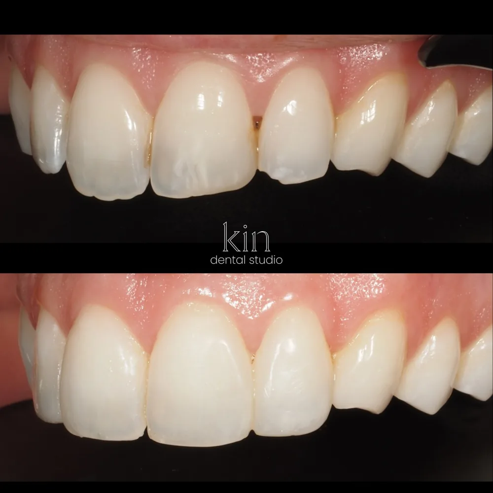 Before and after close-up from a third angle, showing the matched translucency of the resin veneers.