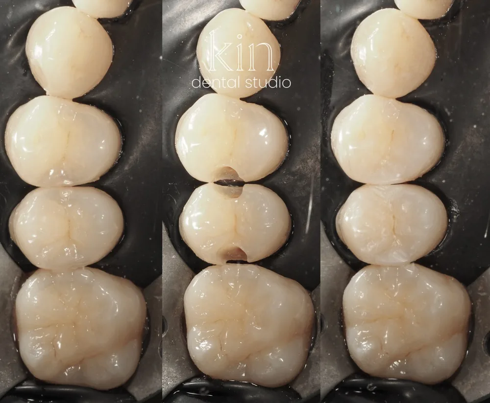 Three-stage sequence of three back teeth against a black background: early decay, then the prepared cavities, then the finished resin restorations shaped to match the natural grooves.