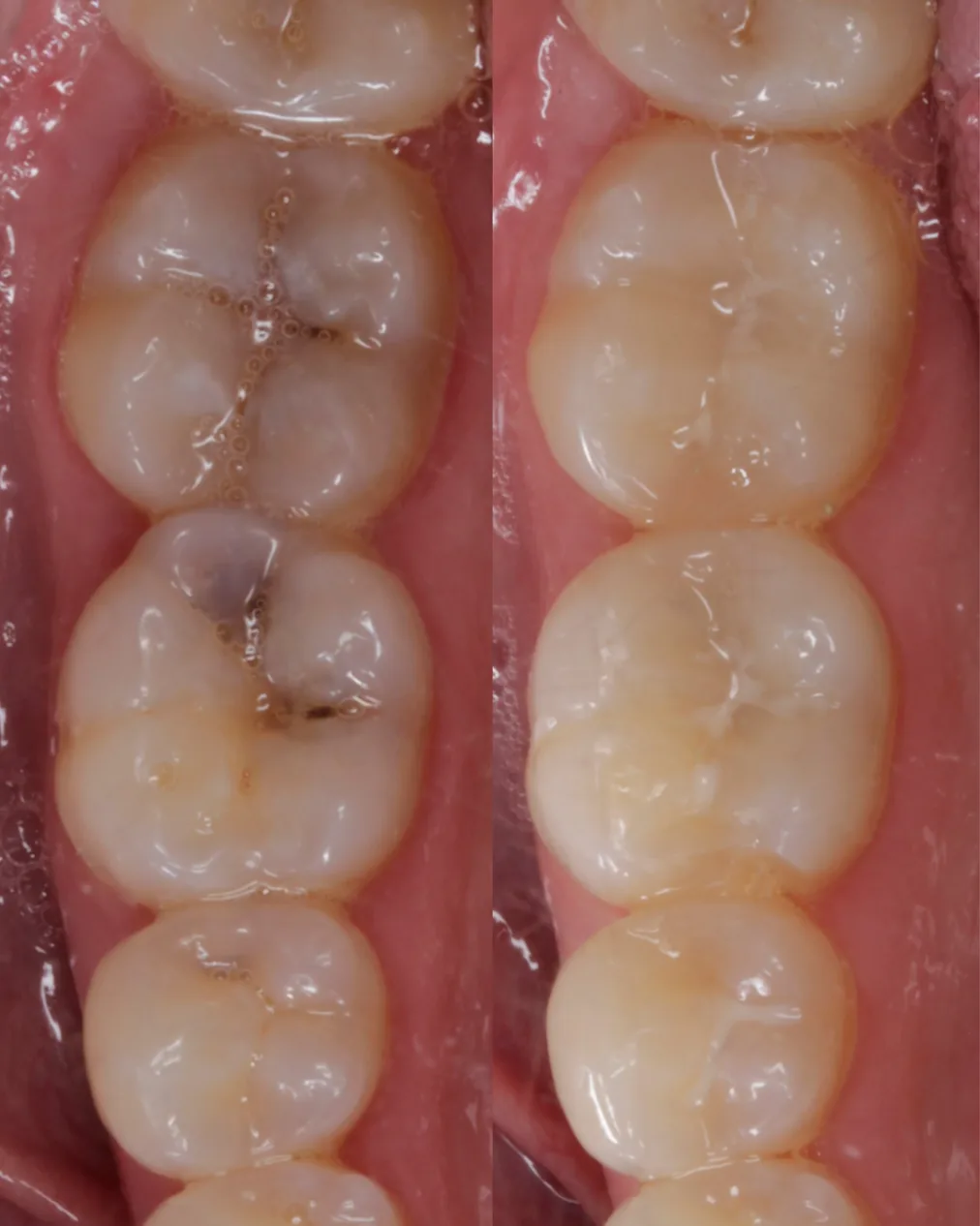 A before and after clinical photograph of two molars: dark decay in the biting surfaces on the left, and the same teeth restored with tooth-coloured fillings on the right.